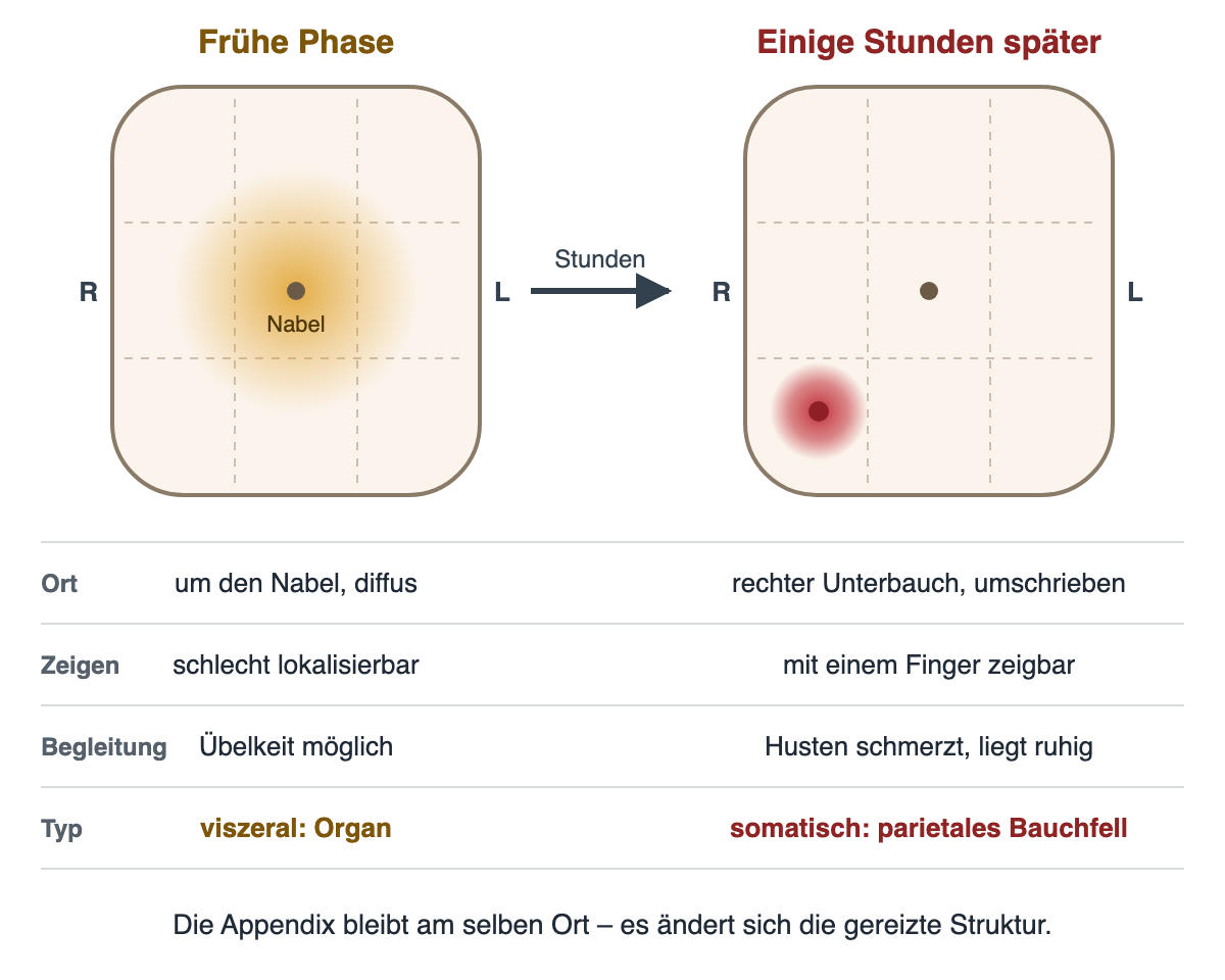 Zwei vereinfachte Bauchumrisse mit neun Feldern. Links, frühe Phase: diffuse gelbe Schmerzzone um den Nabel. Rechts, einige Stunden später: kleiner roter Schmerzpunkt im rechten Unterbauch der Person, im Bild links unten. Darunter die Gegenüberstellung: um den Nabel, diffus, schlecht lokalisierbar, Übelkeit möglich, viszeral – gegenüber rechter Unterbauch, umschrieben, mit einem Finger zeigbar, Husten schmerzt, liegt ruhig, somatisch. Die Appendix bleibt am selben Ort; es ändert sich die gereizte Struktur.