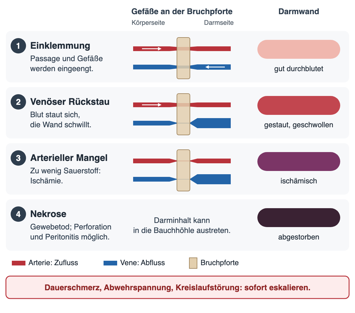 Vier Stufen einer Strangulation an einer Bruchpforte. 1 Einklemmung: Arterie und Vene werden eingeengt, die Darmwand ist noch gut durchblutet. 2 Venöser Rückstau: Der venöse Abfluss ist fast verschlossen, Blut staut sich auf der Darmseite, die Wand ist gestaut und geschwollen. 3 Arterieller Mangel: Auch der arterielle Zufluss ist stark eingeengt, die Wand ist ischämisch. 4 Nekrose: Die Wand ist abgestorben, Darminhalt kann in die Bauchhöhle austreten. Darunter der Hinweis: Dauerschmerz, Abwehrspannung, Kreislaufstörung: sofort eskalieren.