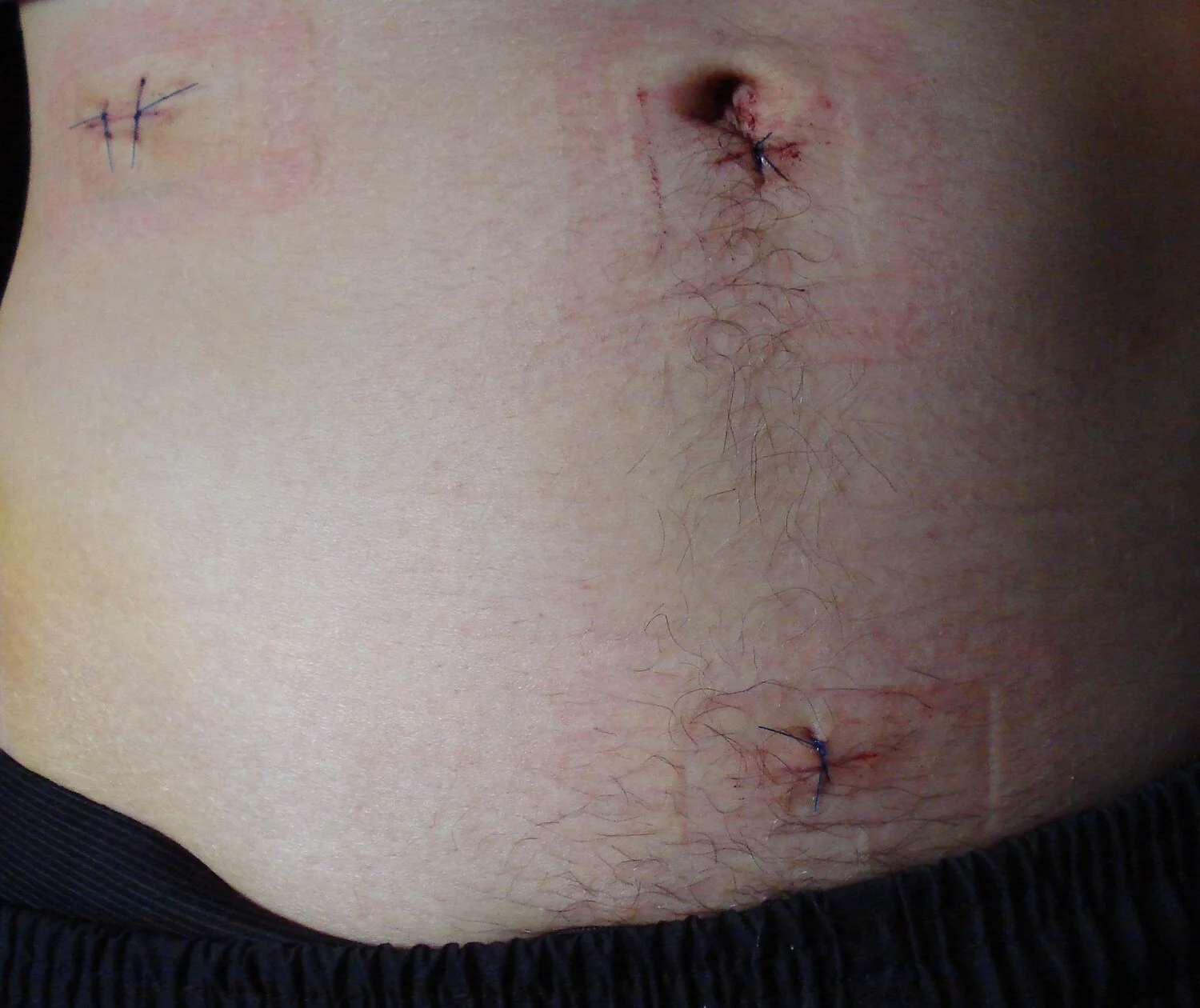 Foto eines Bauchs nach Operation: drei kleine, mit blauen Einzelknopfnähten verschlossene Hautschnitte – einer seitlich oberhalb des Nabels, einer im Nabel und einer im Unterbauch; die Wundränder liegen aneinander, ringsum leichte Rötung und Pflasterabdrücke, am Nabel etwas eingetrocknetes Blut.
