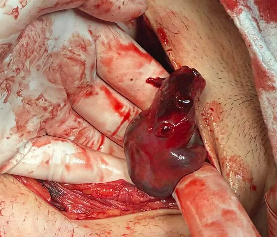 Intraoperatives Foto bei geöffnetem Unterbauch: Eine behandschuhte Hand hält einen dunkelroten, aufgetriebenen und eingerissenen Eileiter; Umgebung und Handschuhe sind blutig.