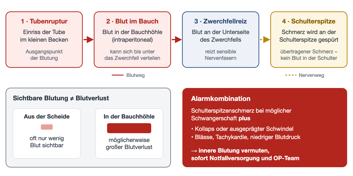 Vier Kästen als Kette von links nach rechts: 1 Tubenruptur im kleinen Becken, 2 Blut in der Bauchhöhle, das sich bis unter das Zwerchfell verteilen kann, 3 Reizung sensibler Nervenfasern an der Unterseite des Zwerchfells, 4 Schmerz an der Schulterspitze als übertragener Schmerz; die ersten Pfeile sind rot für den Blutweg, der letzte gestrichelt golden für den Nervenweg. Darunter links der Vergleich wenig sichtbarer vaginaler Blutung mit möglicherweise großem Blutverlust in der Bauchhöhle, rechts in Rot die Alarmkombination aus Schulterspitzenschmerz bei möglicher Schwangerschaft mit Kollaps, Schwindel, Blässe, Tachykardie oder niedrigem Blutdruck.