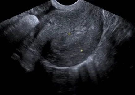 Transvaginaler Ultraschall, Längsschnitt des Uterus: gleichmäßig strukturierte Gebärmutterwand, in der Gebärmutterhöhle keine Fruchthöhle abgrenzbar; zwei gelbe Messkreuze aus der Originalaufnahme.
