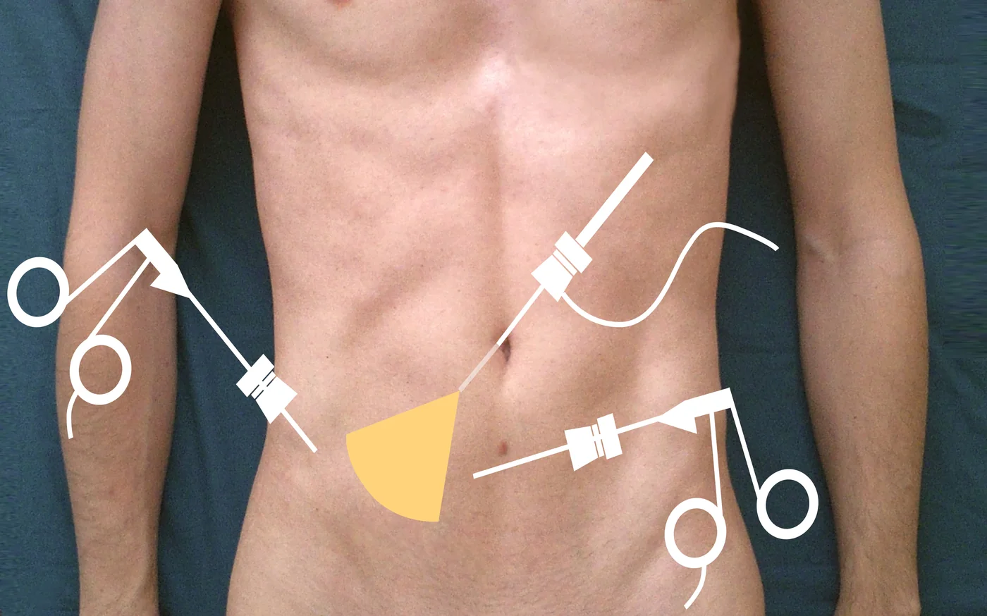Bauch eines liegenden schlanken Mannes von vorn. Eingezeichnet sind drei Instrumente: eine Kamera mit Kabel, die am Nabel eintritt, sowie zwei Greif- und Arbeitsinstrumente, eines in der rechten Flanke der Person (im Bild links) und eines im linken Unterbauch (im Bild rechts). Ein gelber Fächer vor der Kameraspitze markiert das Blickfeld im rechten Unterbauch der Person.
